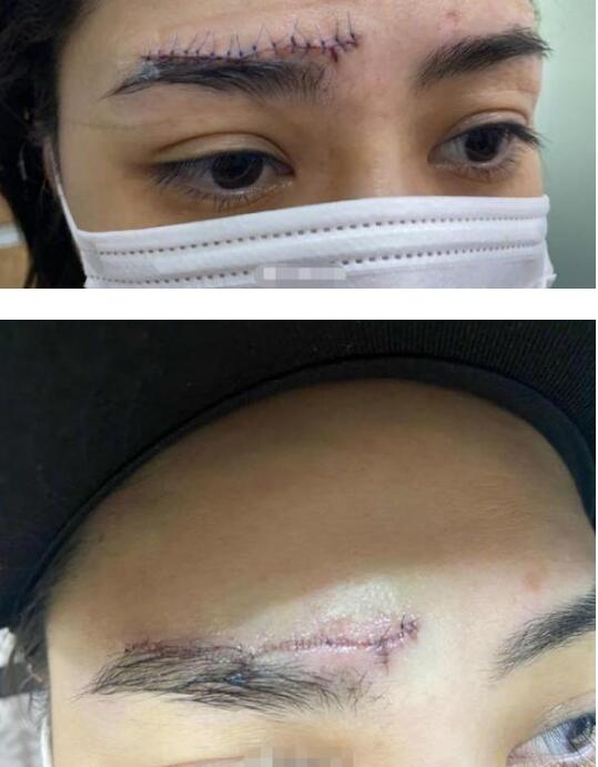 阿娇晒伤口照片怎么回事?阿娇是怎么受伤的?