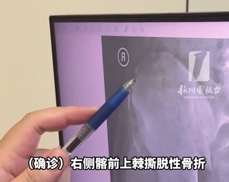 男孩每天坚持猛跑1小时把骨头跑断了 医生：近期已接诊三四例