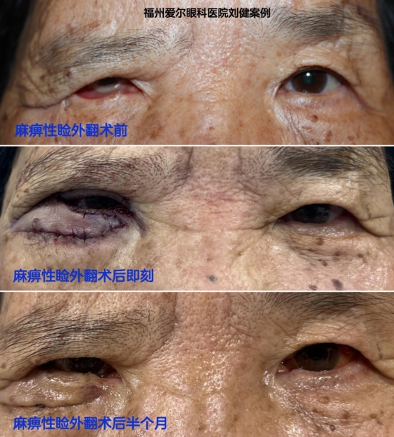 眼皮外翻，七旬阿姨迎风刺痛、流泪，终日捂眼生活