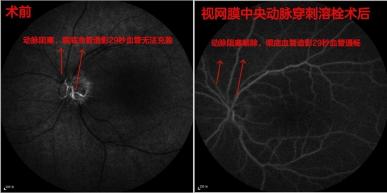 男子午睡醒来眼前白茫茫一片,洗眼睛、点药水无济于事,幸亏就诊及时