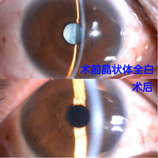 女子黑眼珠变白近乎失明！医生提醒：这类眼病久拖，风险呈几何级数上升