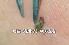 女子被蜱虫咬伤住ICU28天四肢瘫痪 确诊森林脑炎医疗费已花40万元